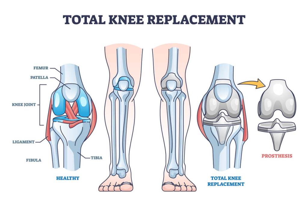 Say Goodbye to Knee Pain with the Best Knee Surgeon in Greater Noida